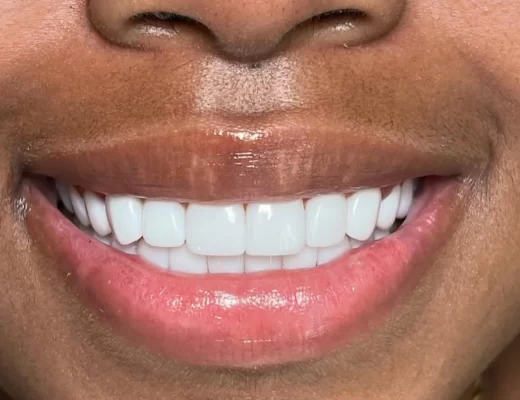 Qualifications For Teeth Whitening