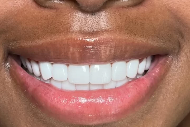 Qualifications For Teeth Whitening