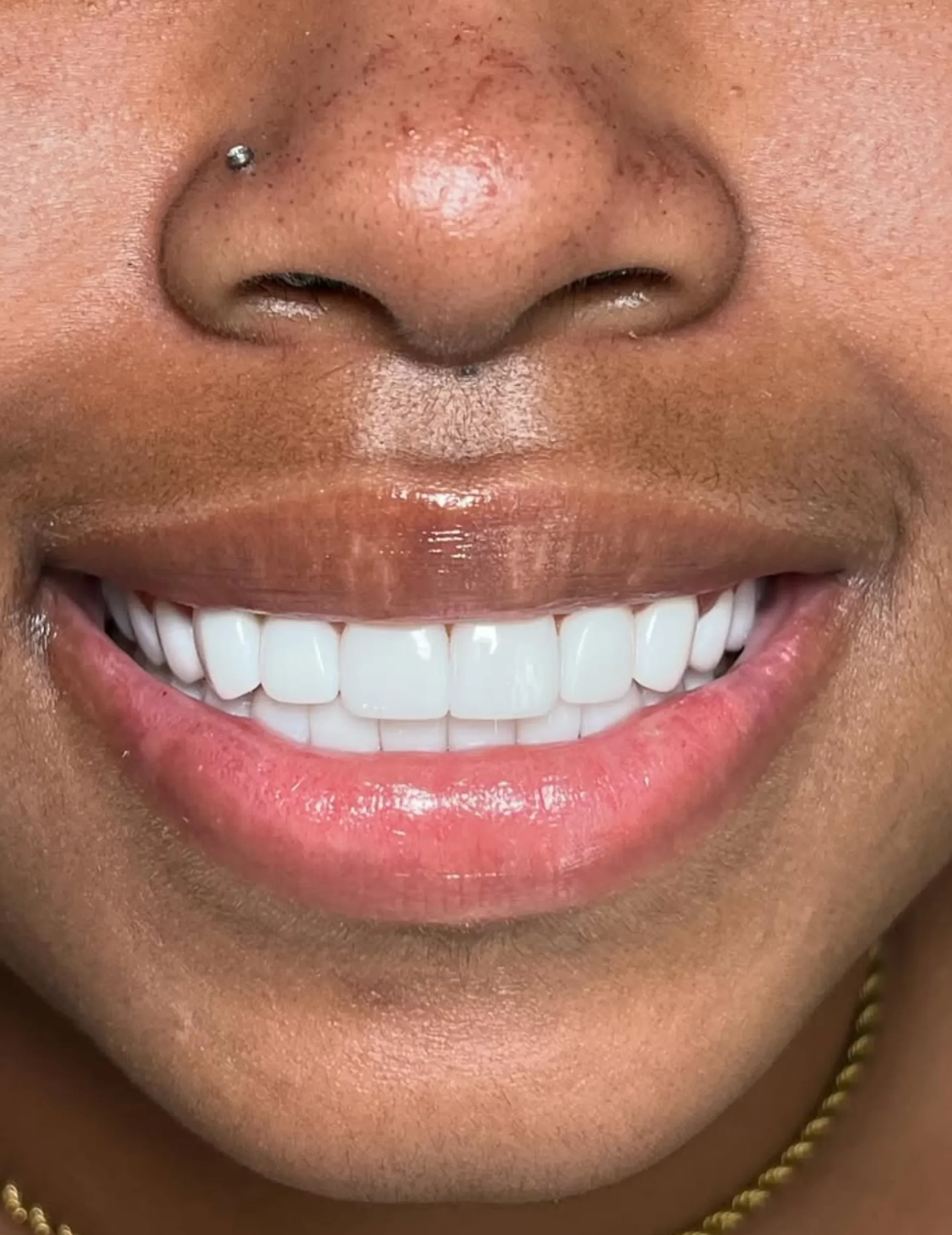 Qualifications For Teeth Whitening