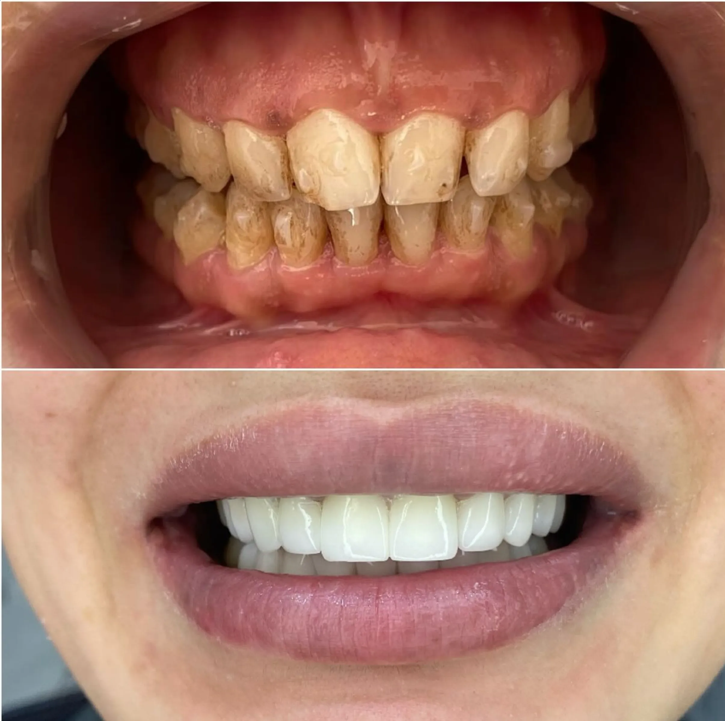non-dentist teeth whitening legality