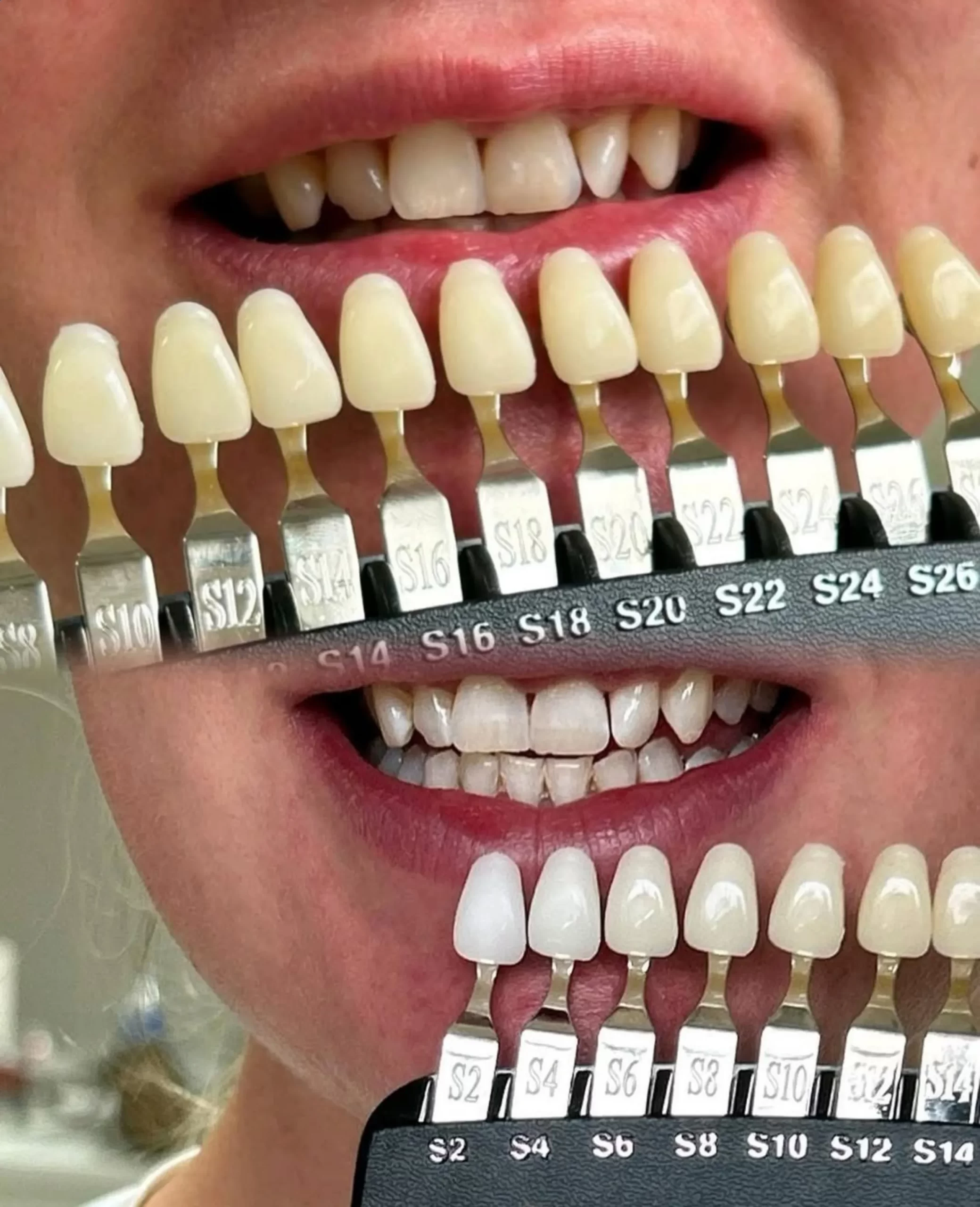 teeth whitening in Australia