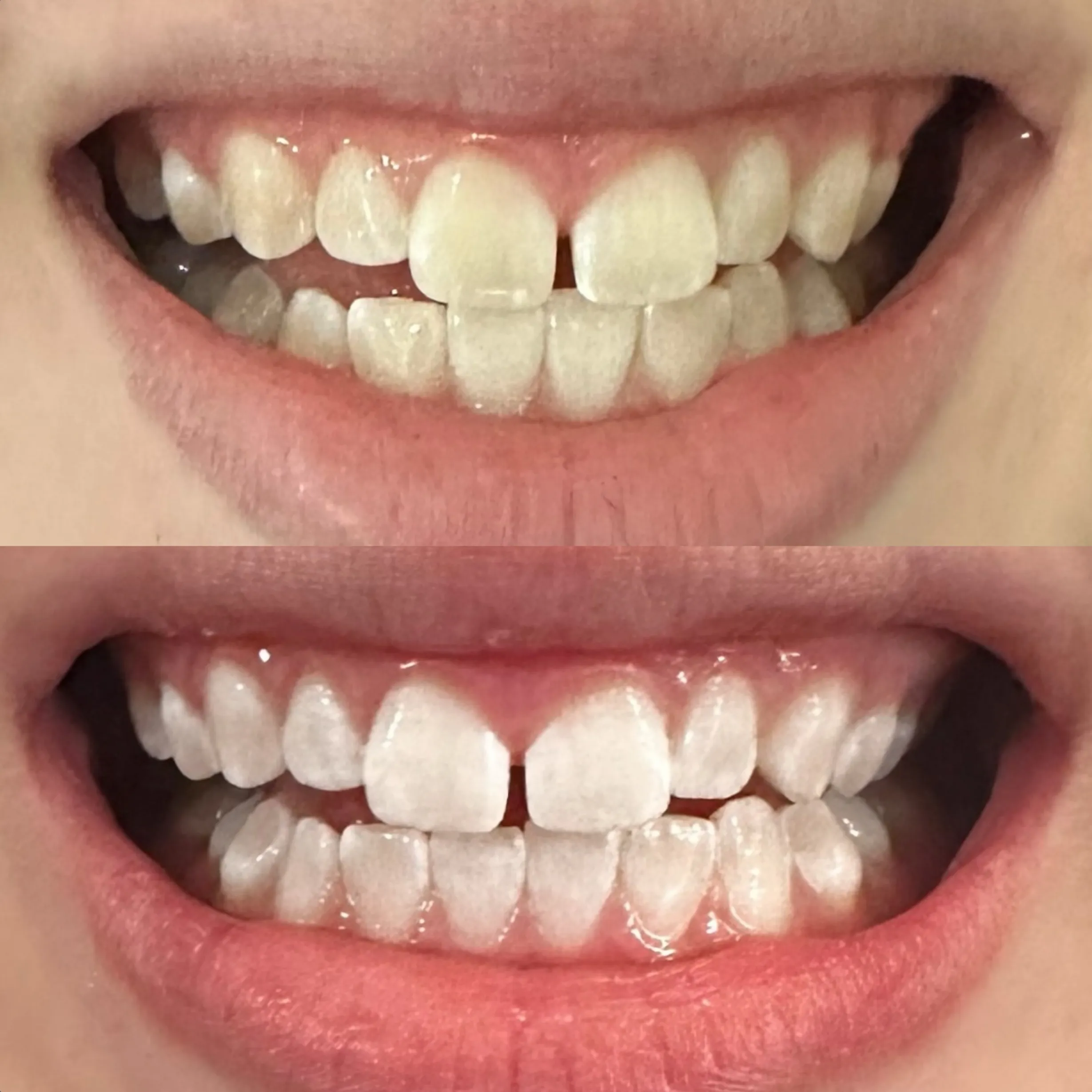 teeth whitening regulations Australia