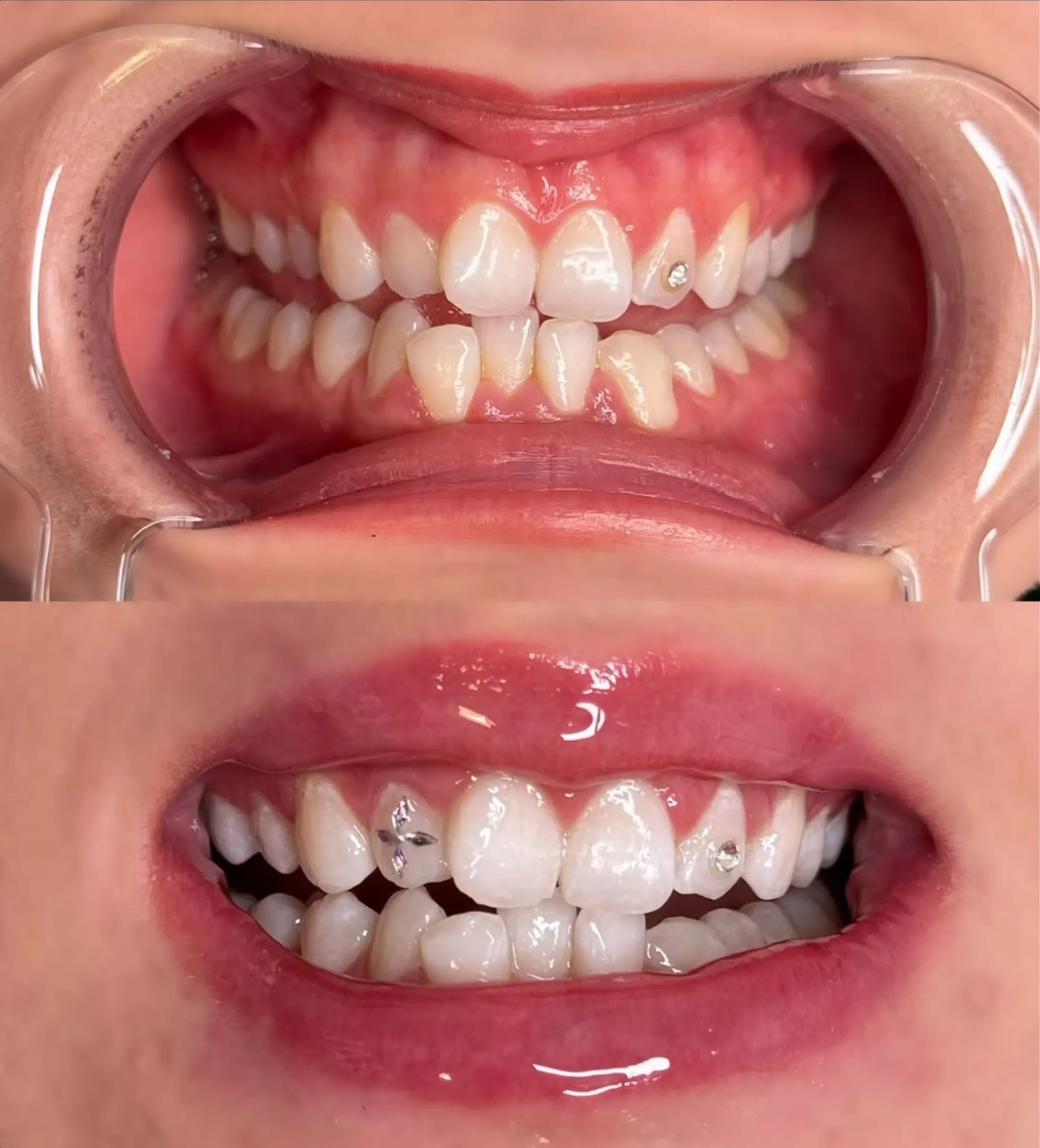 teeth whitening rules