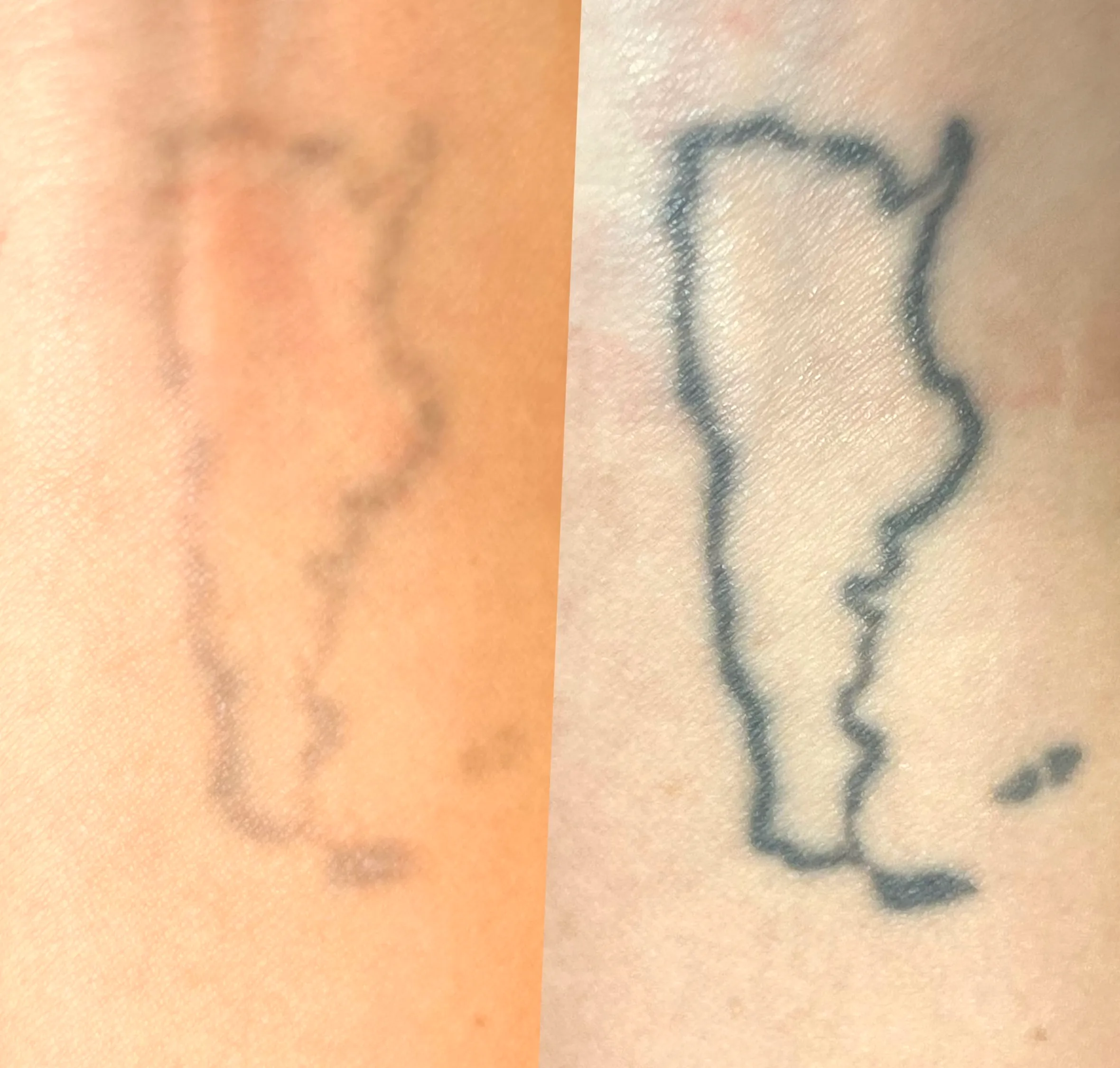 laser tattoo removal licence states