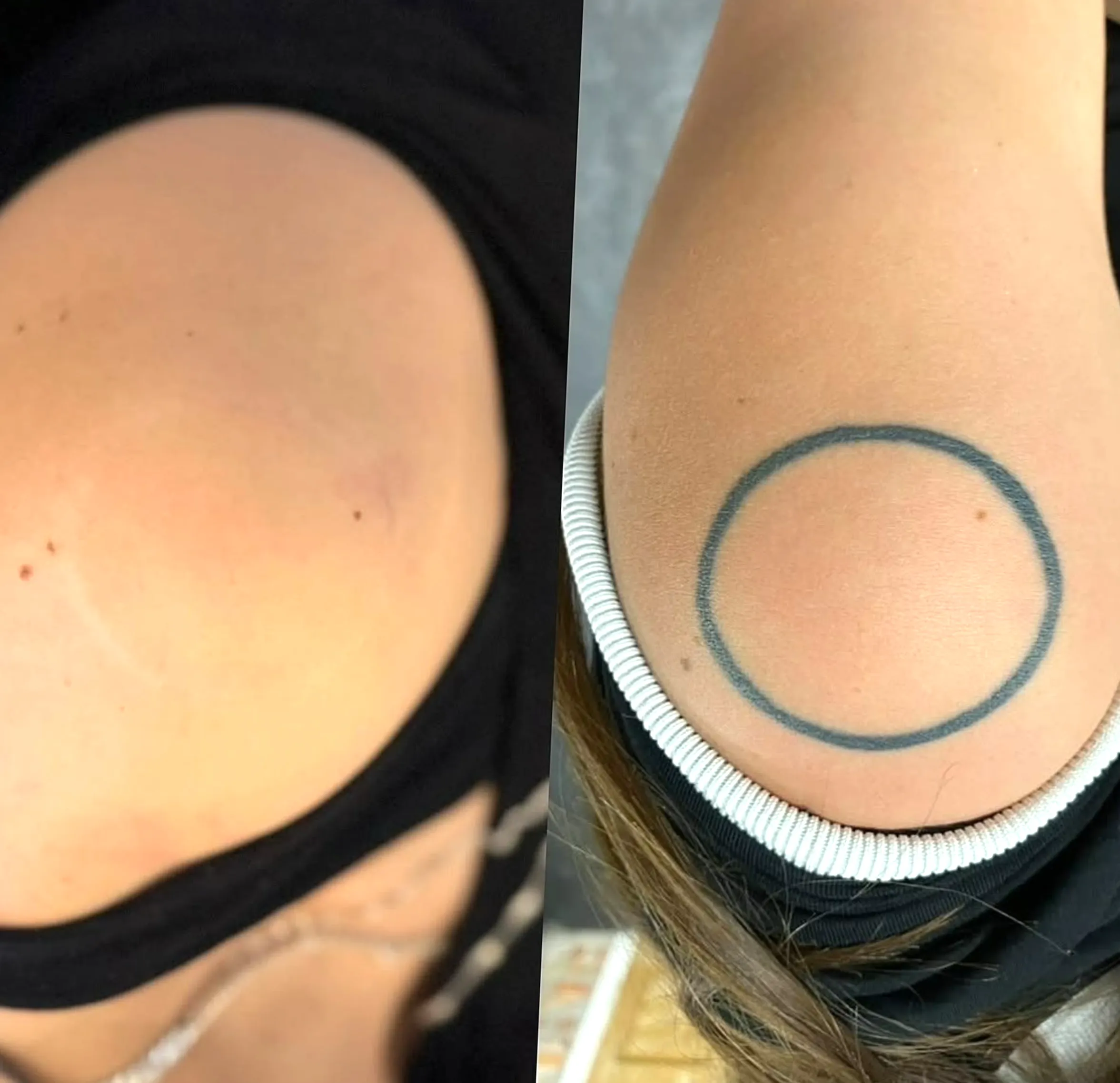 tattoo removal council requirements