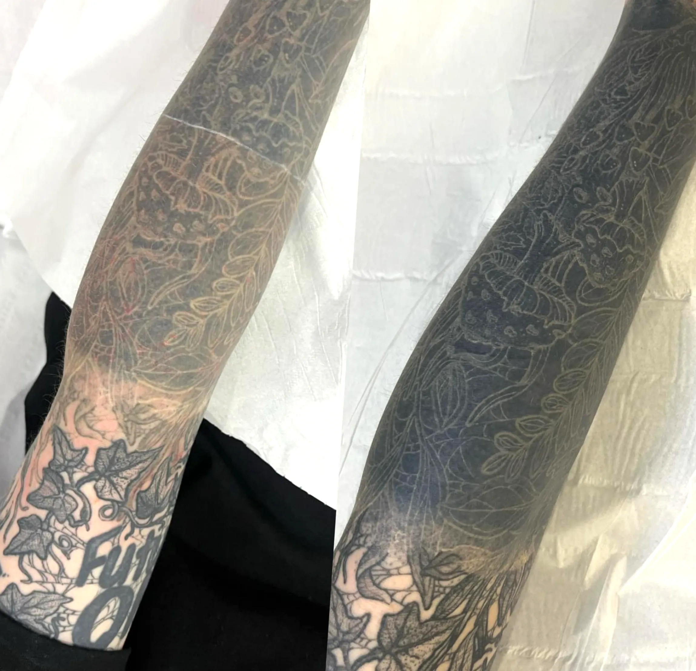tattoo removal course interstate