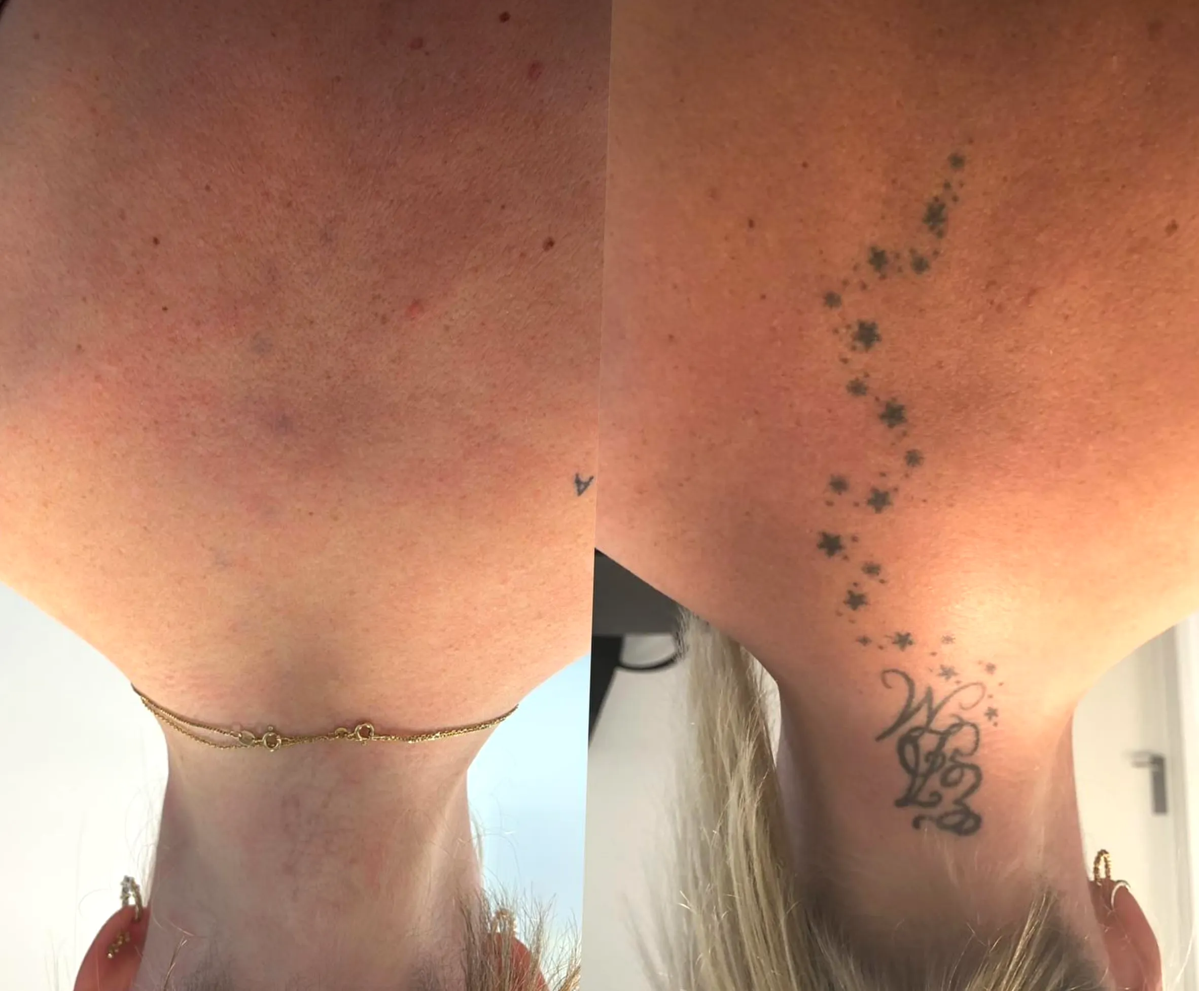 tattoo removal licence Australia