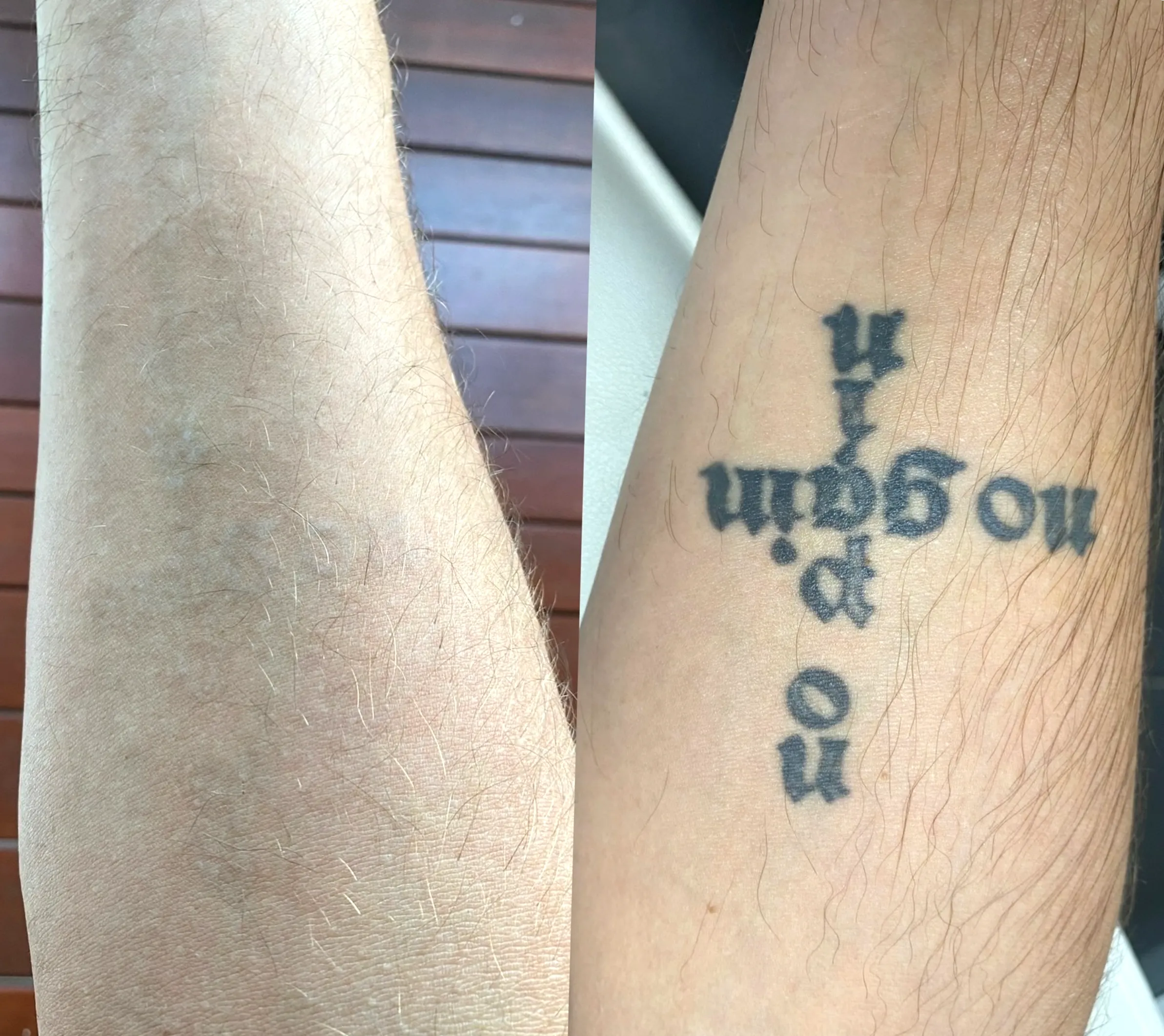 tattoo removal training recognised Australia