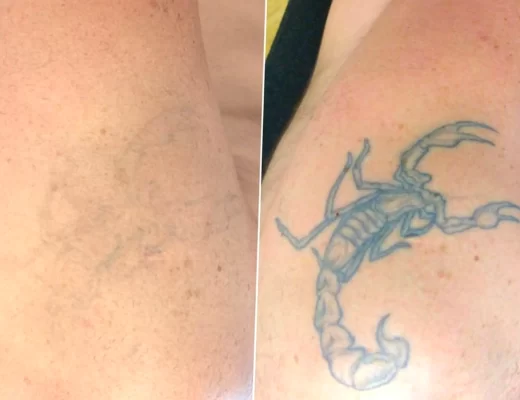 tattoo removal working interstate