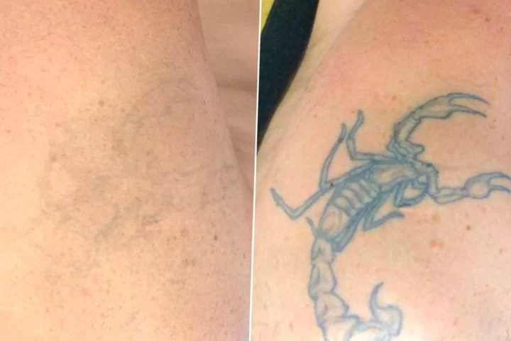 tattoo removal working interstate