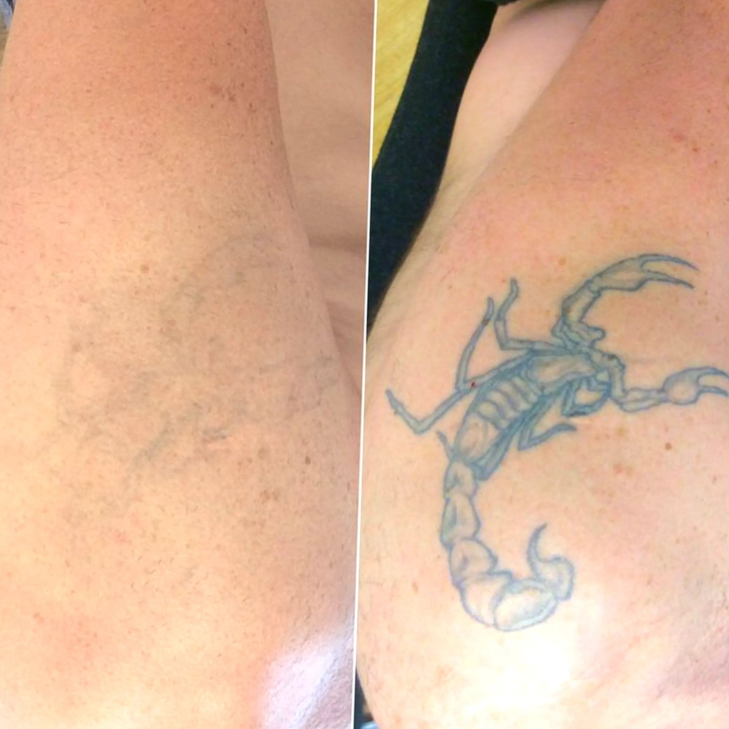 tattoo removal working interstate
